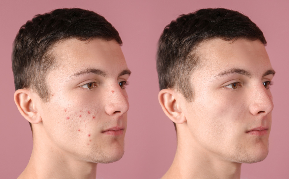 Androgenos y acne